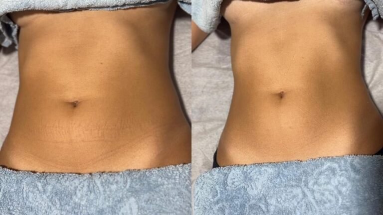 1 SESSÃO DE DRENAGEM LINFÁTICA